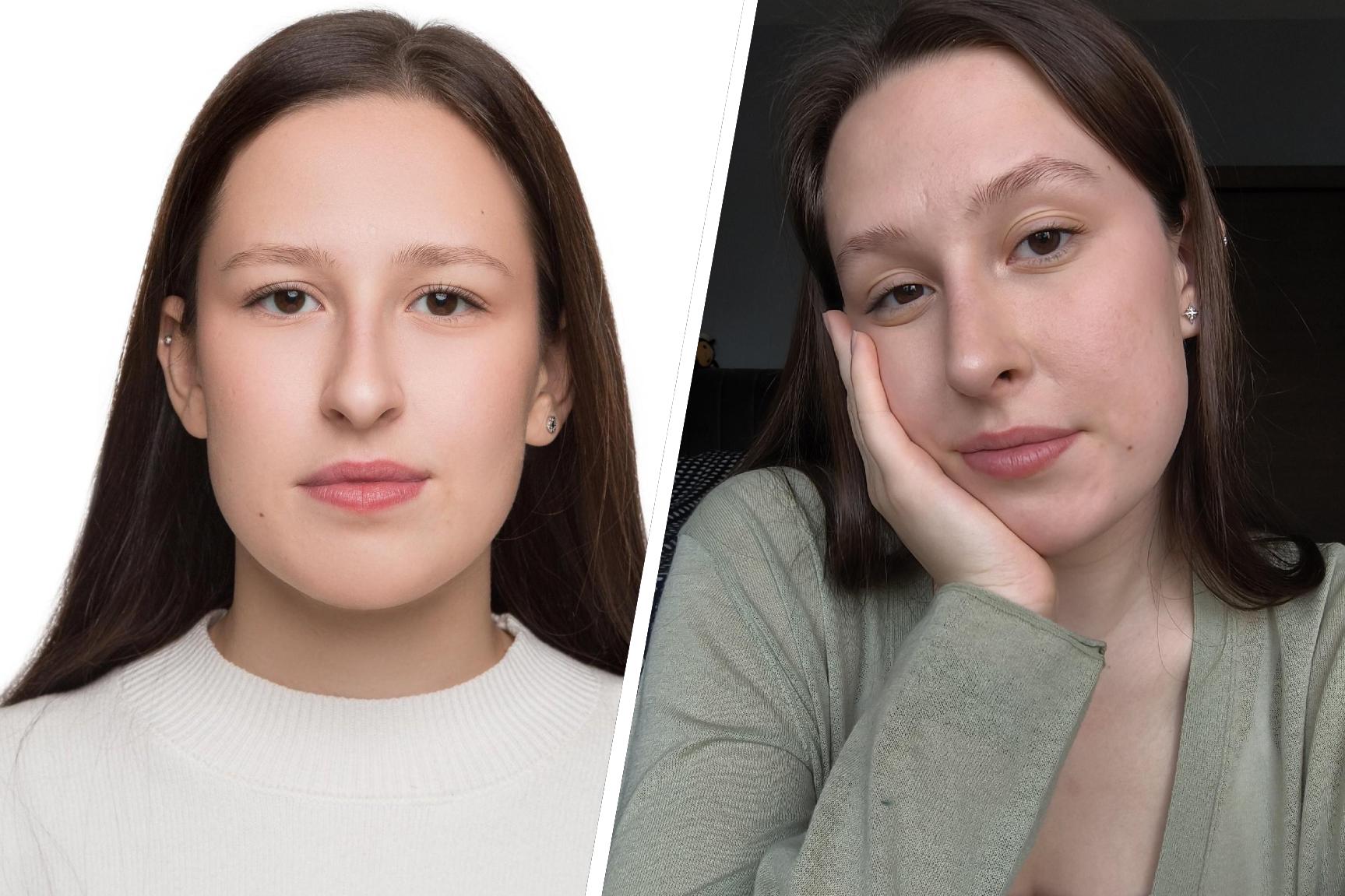 Пермячка рассказала о риносептопластике: цена, процесс и результаты